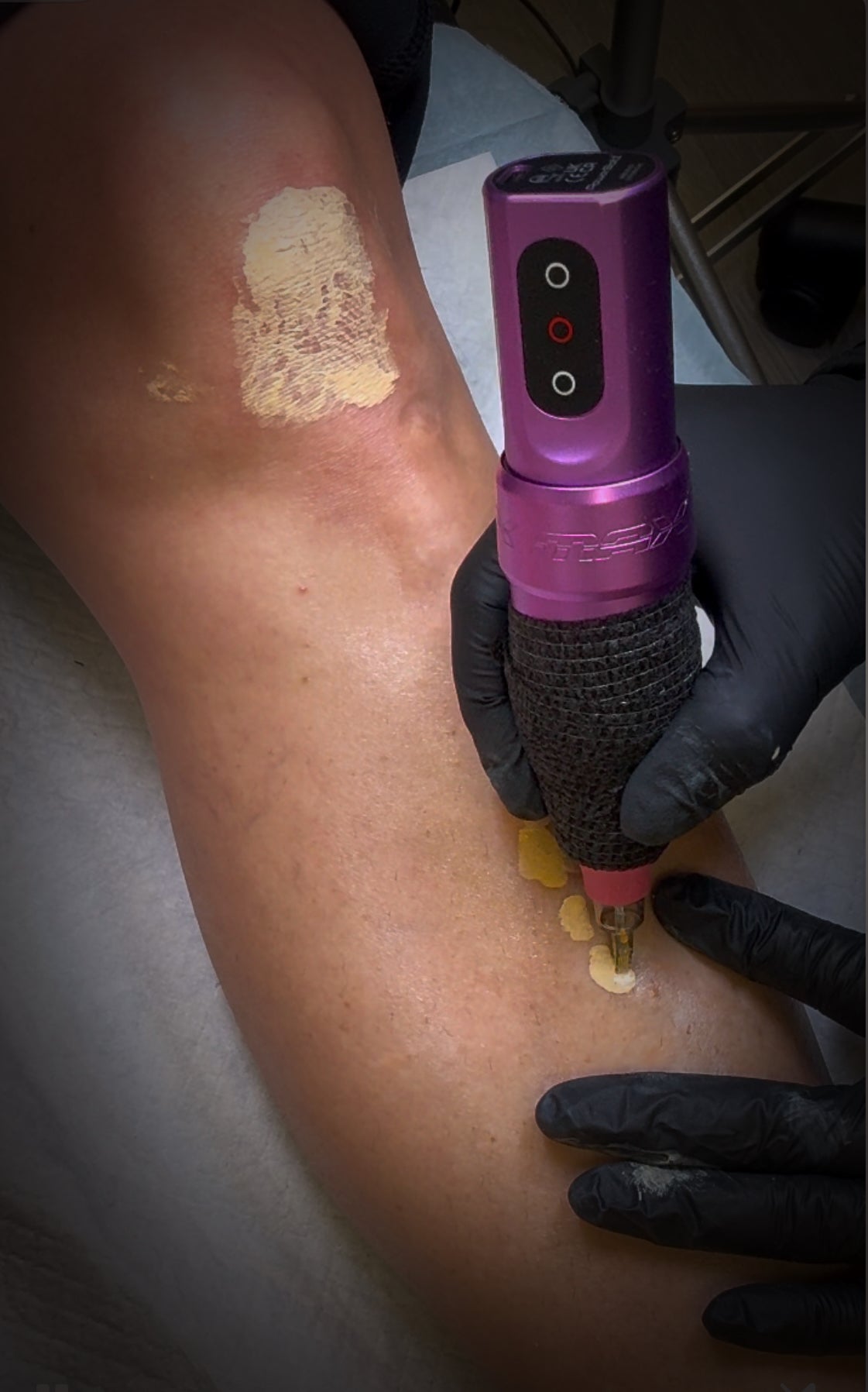 Scar Regeneration