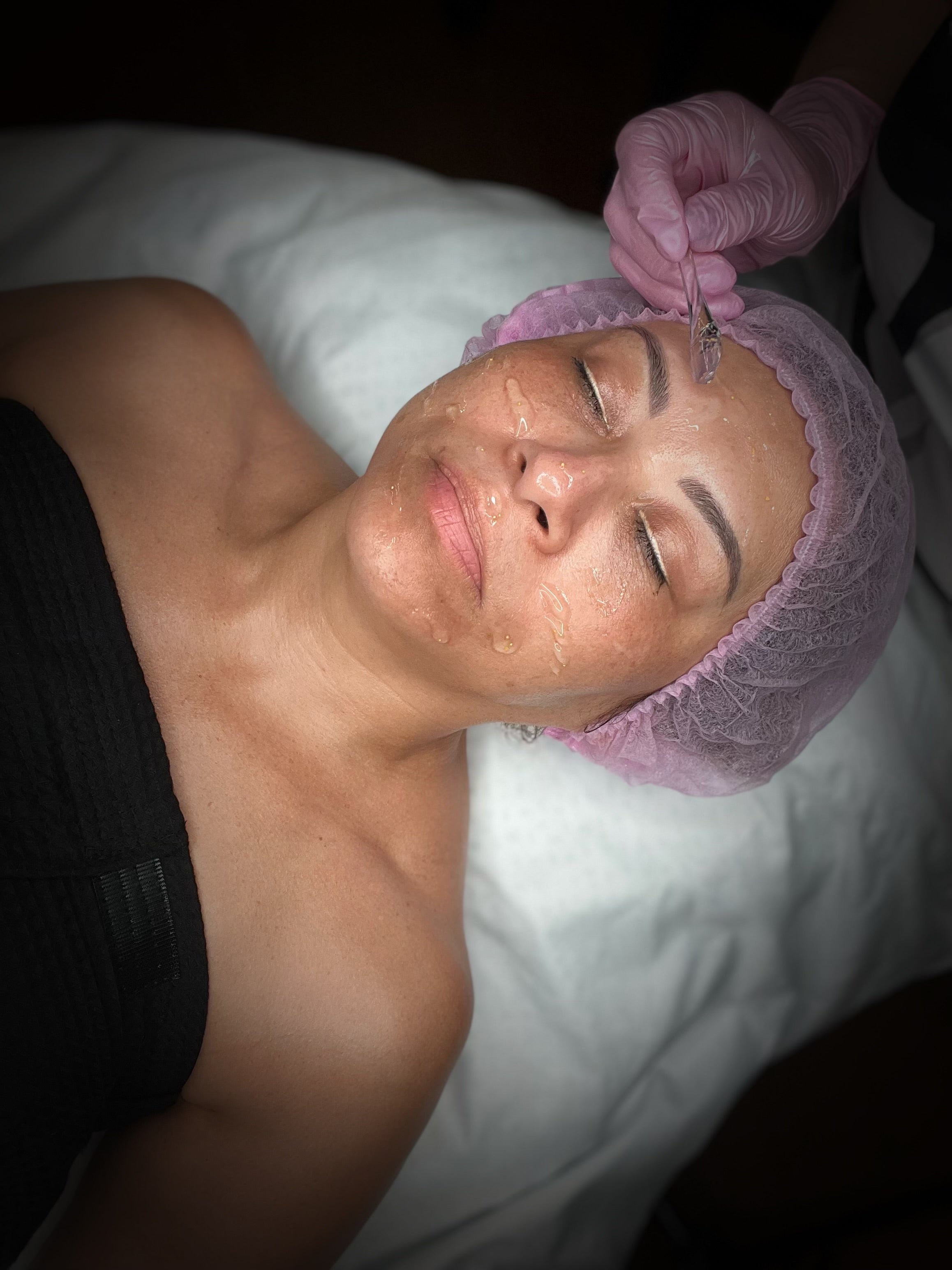 Acne Facial