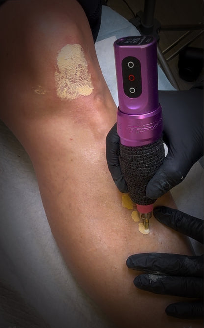 Scar Regeneration