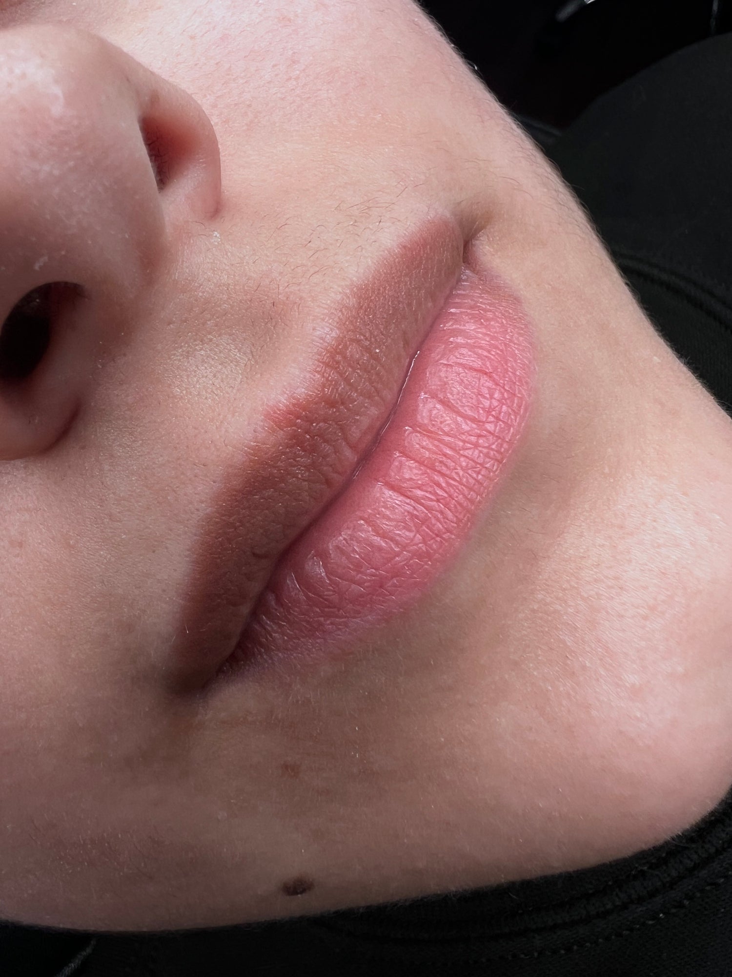 Lips Neutralization