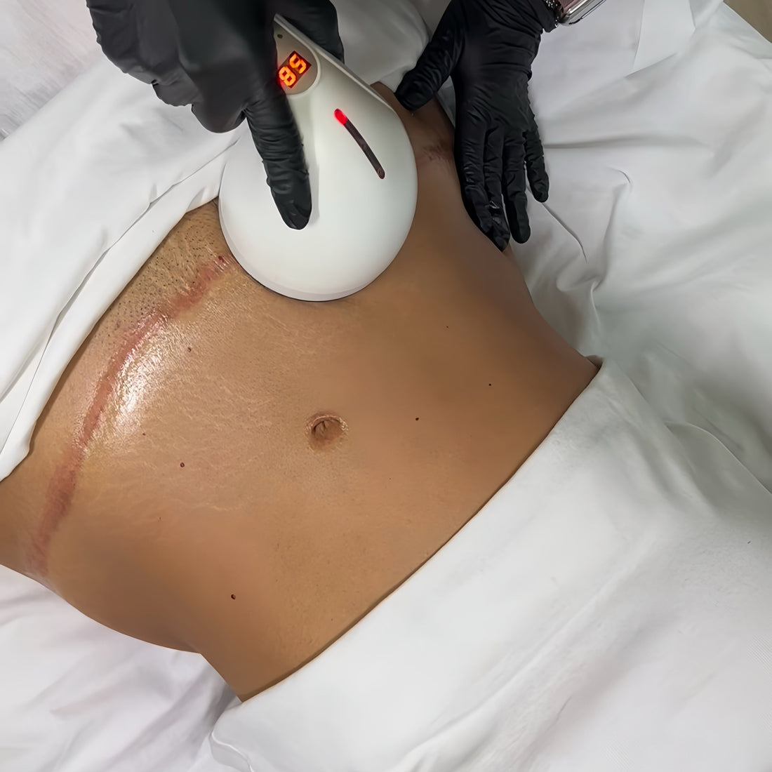 Scar Regeneration