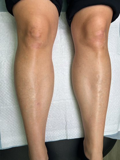 Scar Regeneration